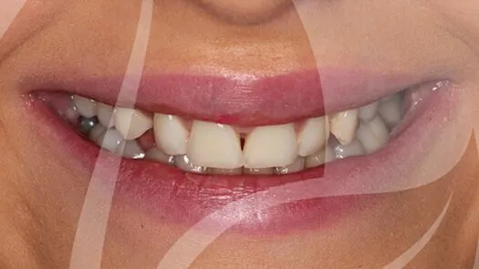 Whitening & cosmetic bonding makeover