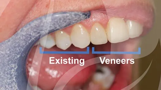 Ultra natural veneers