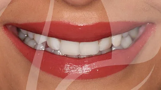 Whitening & cosmetic bonding makeover