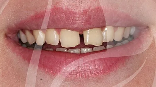 Composite bonding gap closure
