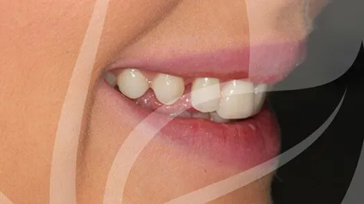 Whitening & cosmetic bonding makeover