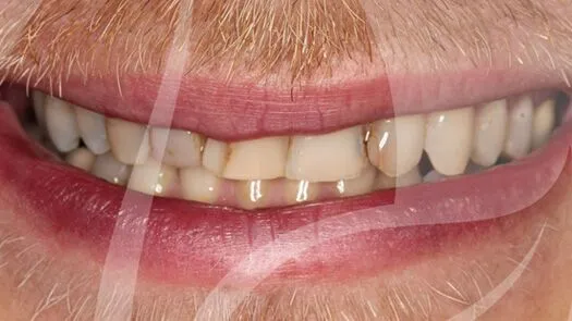 Veneers and implants makeover