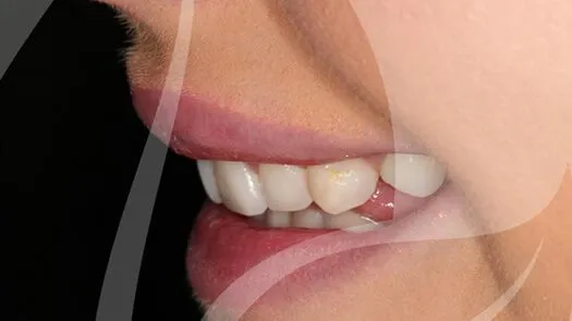 Whitening & cosmetic bonding makeover