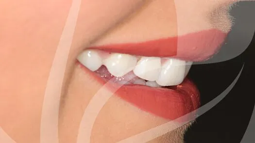 Whitening & cosmetic bonding makeover