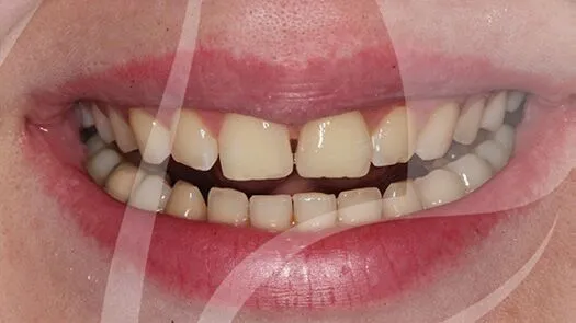 Composite bonding gap closure