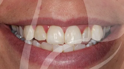 Whitening of severely discoloured teeth