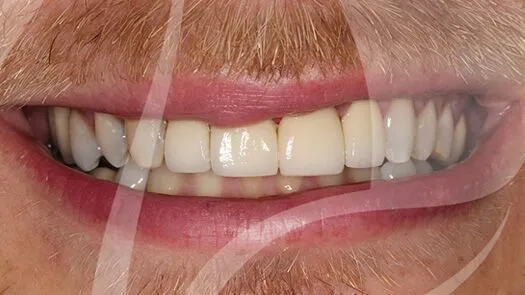 Veneers and implants makeover