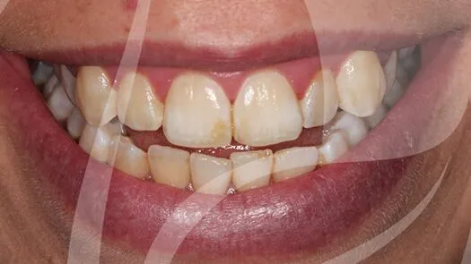 Whitening of severely discoloured teeth