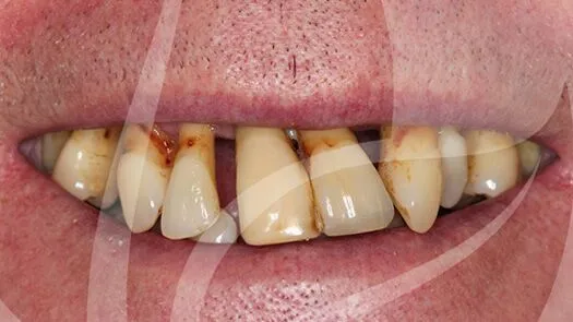 Implant makeover