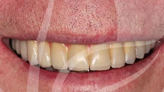 Implant makeover
