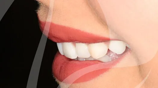 Whitening & cosmetic bonding makeover