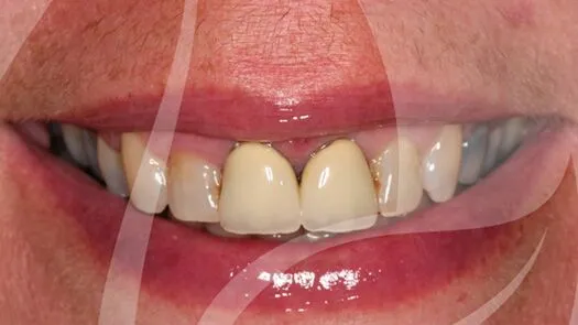 Crown replacements with cosmetic crowns