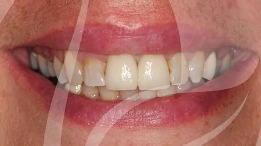 Crown replacements with cosmetic crowns